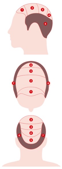 Diagramme des zones de calvitie
